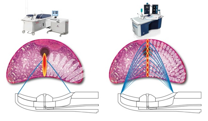 Ablatherm Versus Focal One