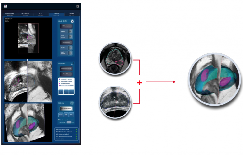 module de fusion élastique avec IRM